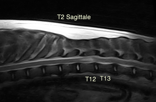 L’examen IRM confirme un œdème intra-médullaire en regard du disque dégénéré T12-T13 (hyperintensité T2).